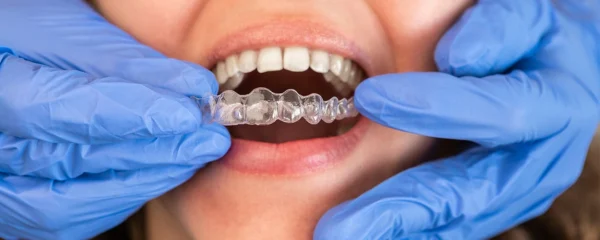 L’orthodontie invisible chez l’adulte